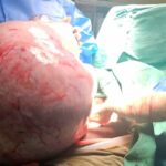 Una paciente fue operada de un tumor de 14 kilos en Mozambique